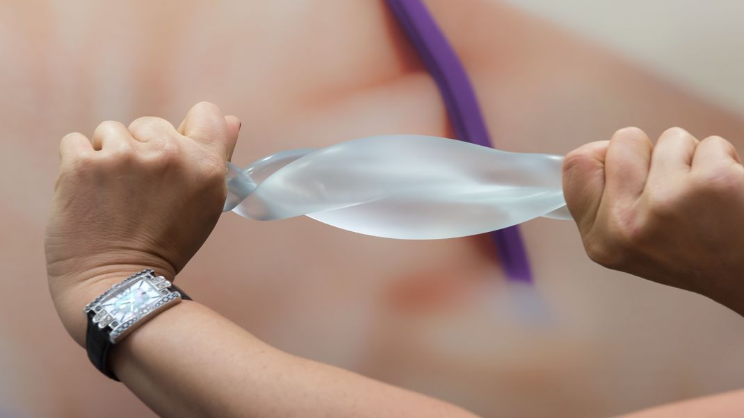 Dank neuer Technologie sind Brustimplantate sehr dehnbar und strapazierfähig und eine Ruptur ist fast kein Risiko mehr - aber eben nur fast.